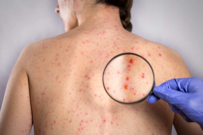 Epidemic,Rubella,Viral,Infection,Concept.,Skin,Bubble,Rash