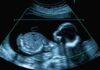 Preeclampsia Linked To SURGING Kidney Risk Fetal ultrasound scan image