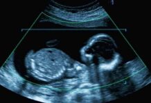Preeclampsia Linked To SURGING Kidney Risk Fetal ultrasound scan image